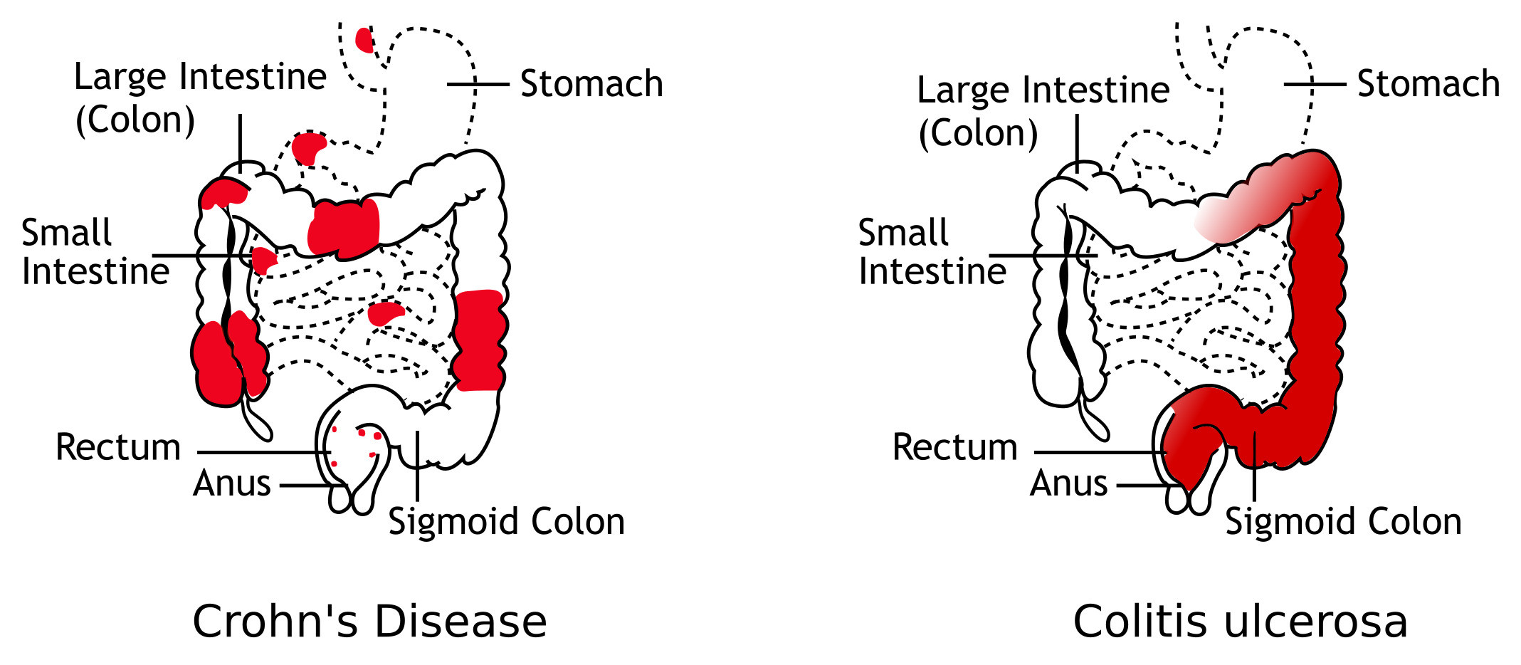 Crohn's Disease vs Colitis